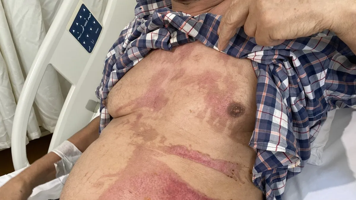 Lavabo açıcı bomba gibi patladı: Vücudunun yüzde 40’ı yandı!